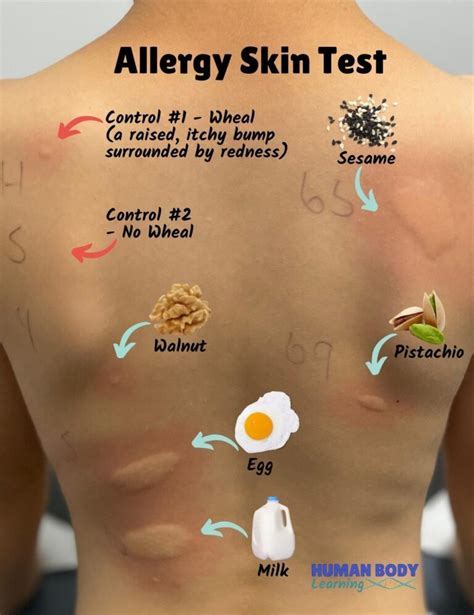 food allergy testing for kids